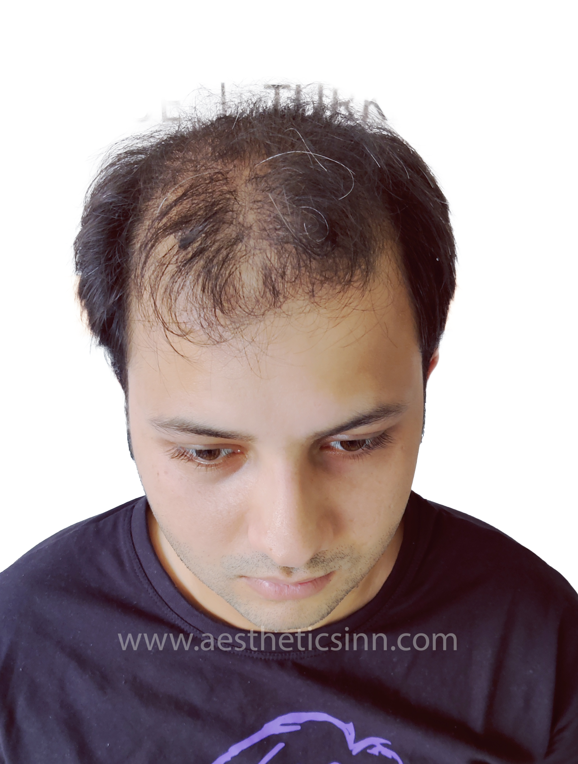 Before Hair Transplant - Hamza Kahloon