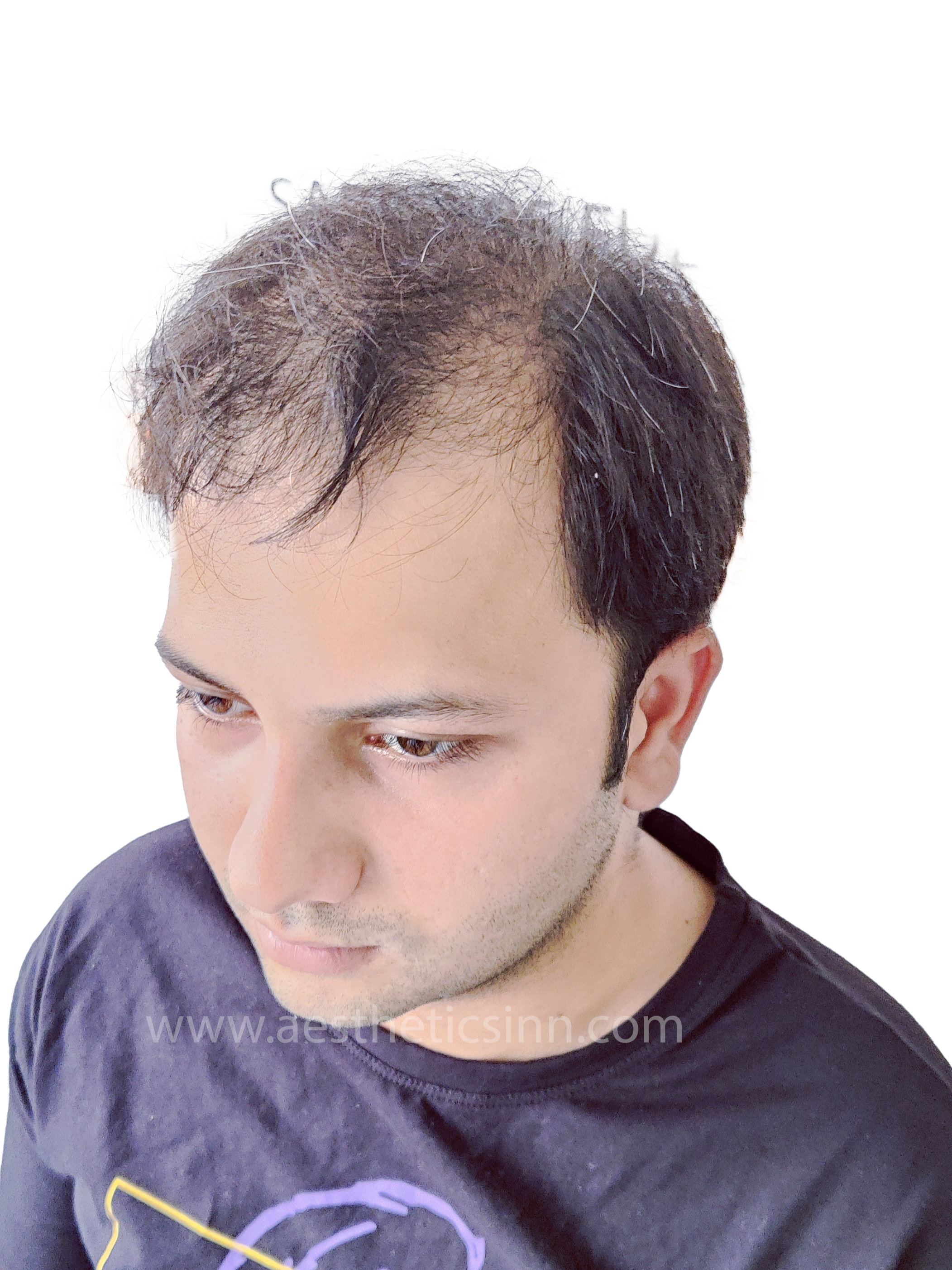 Hamza Kahloon Right Profile Before