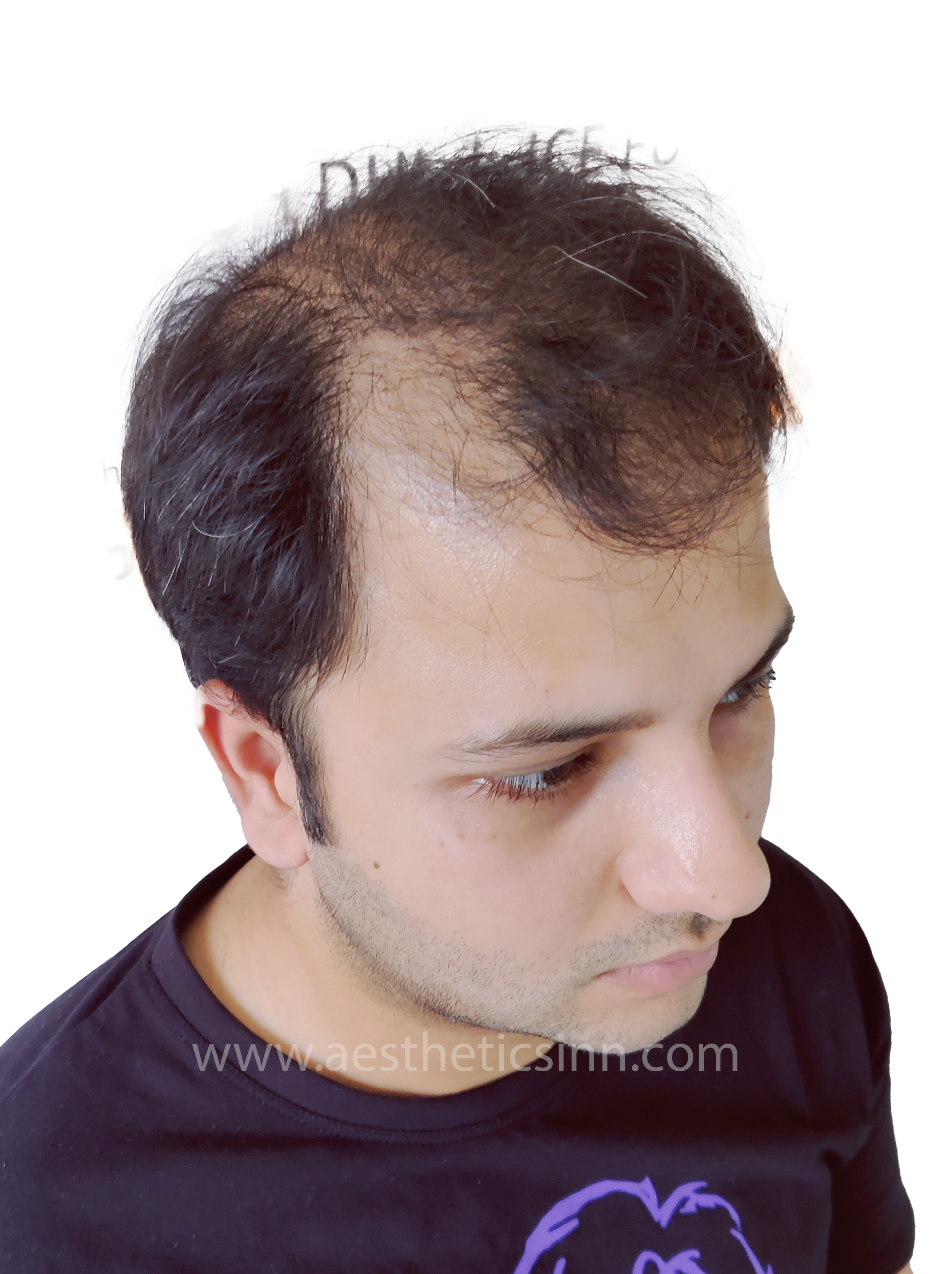Hamza Kahloon Left Profile Before