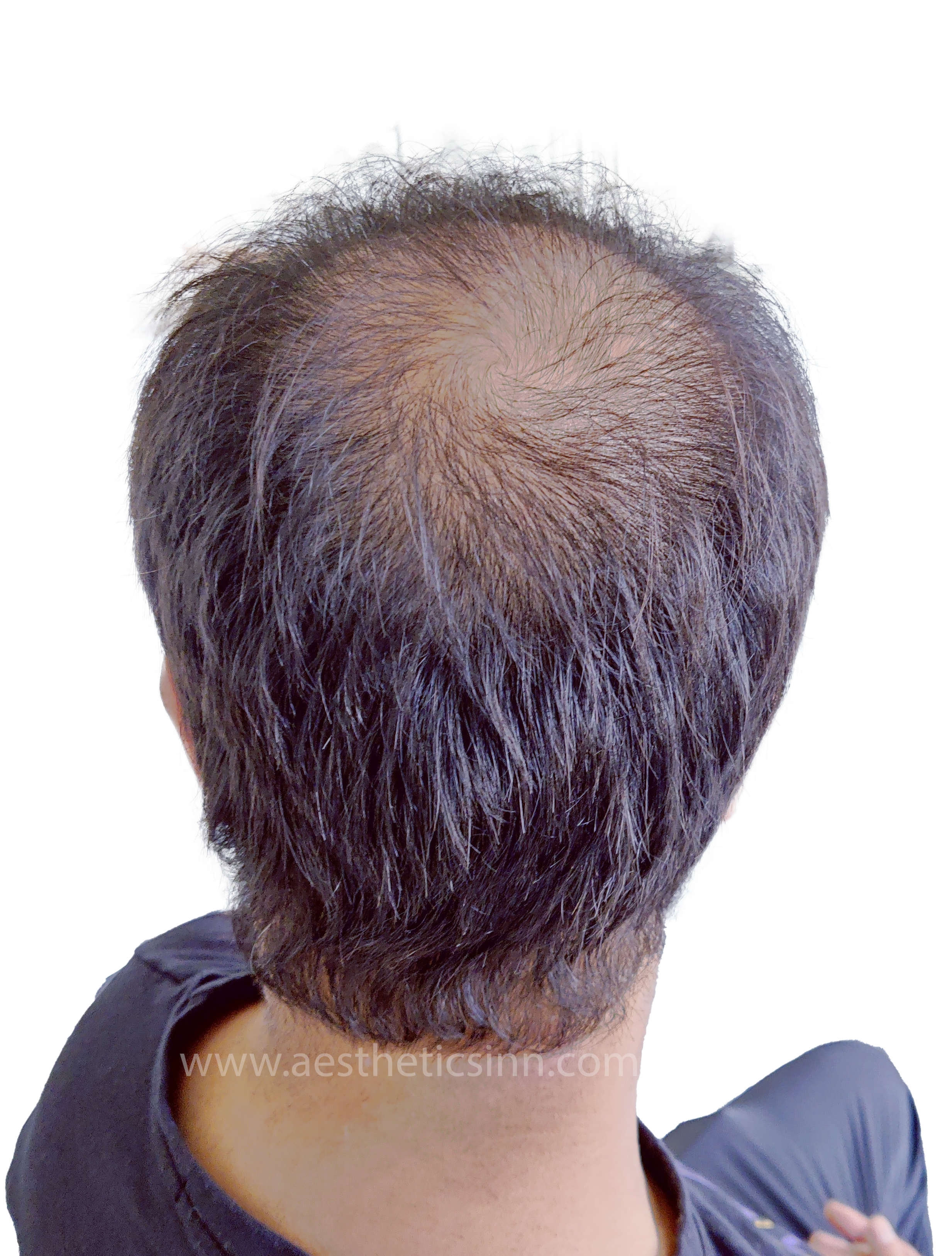 Hamza Kahloon Posterior Crown Before