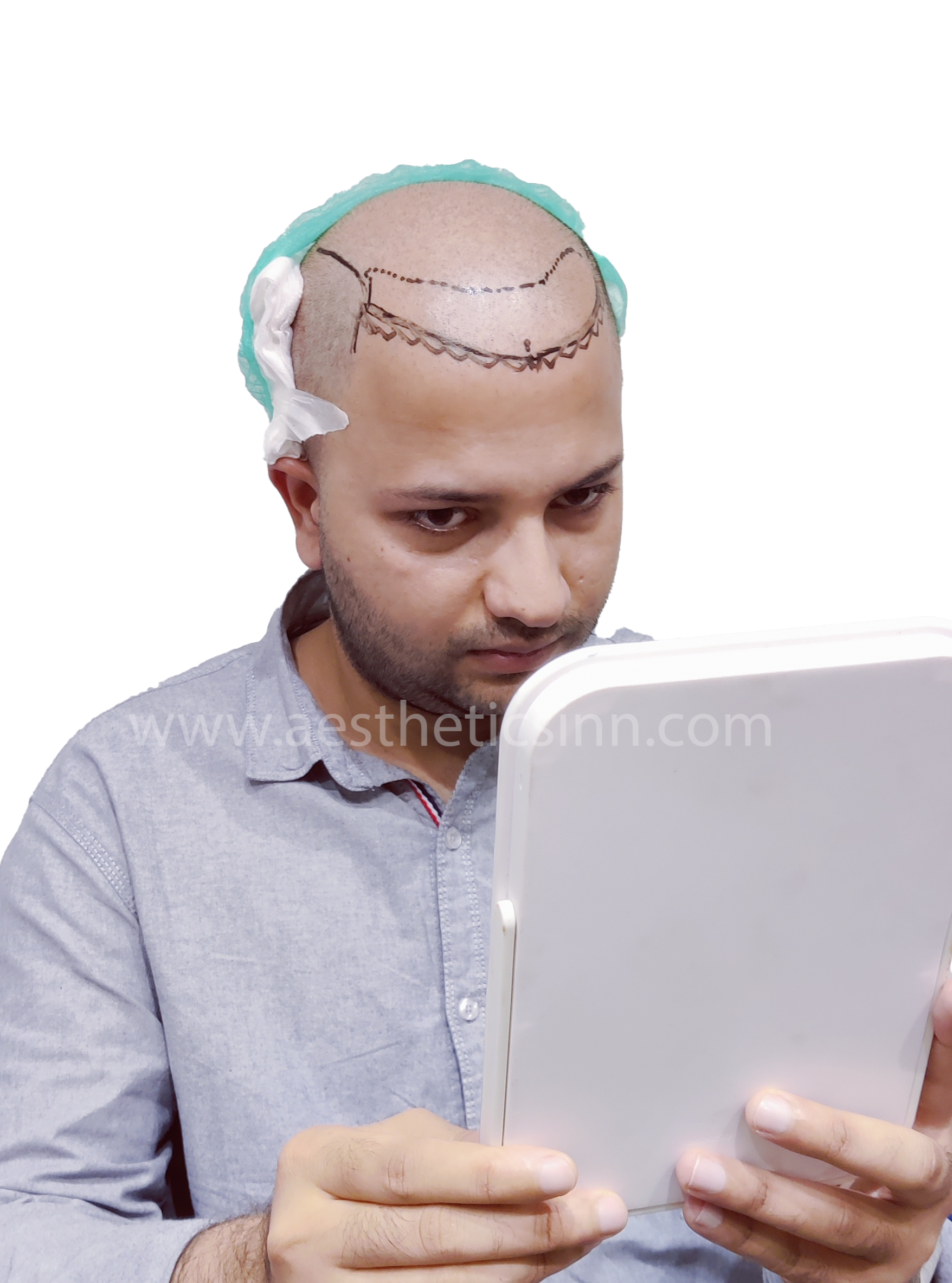 Hamza Kahloon Pre-Op Hairline Design