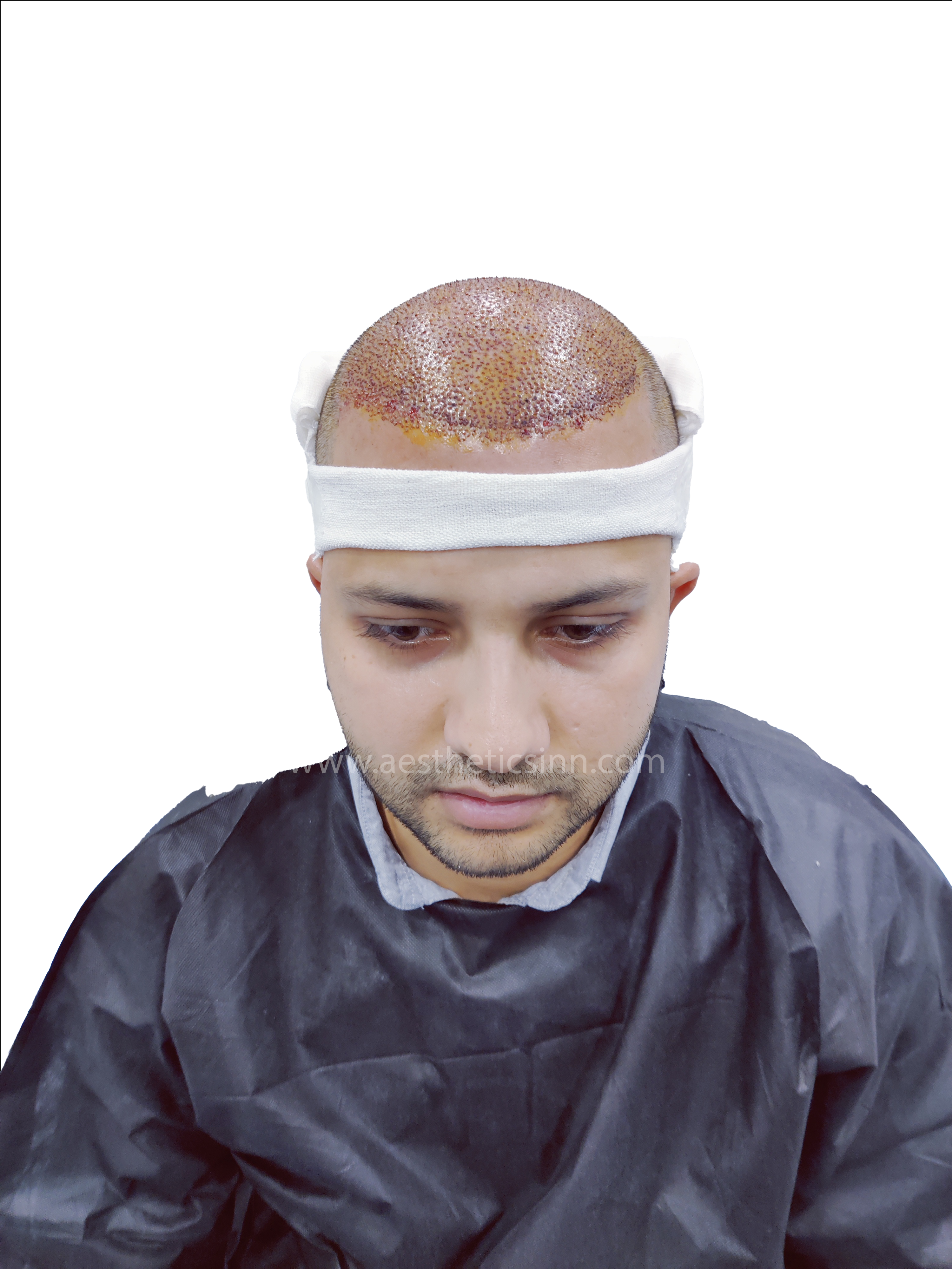 Hamza Kahloon Frontal Post-Op Day 0