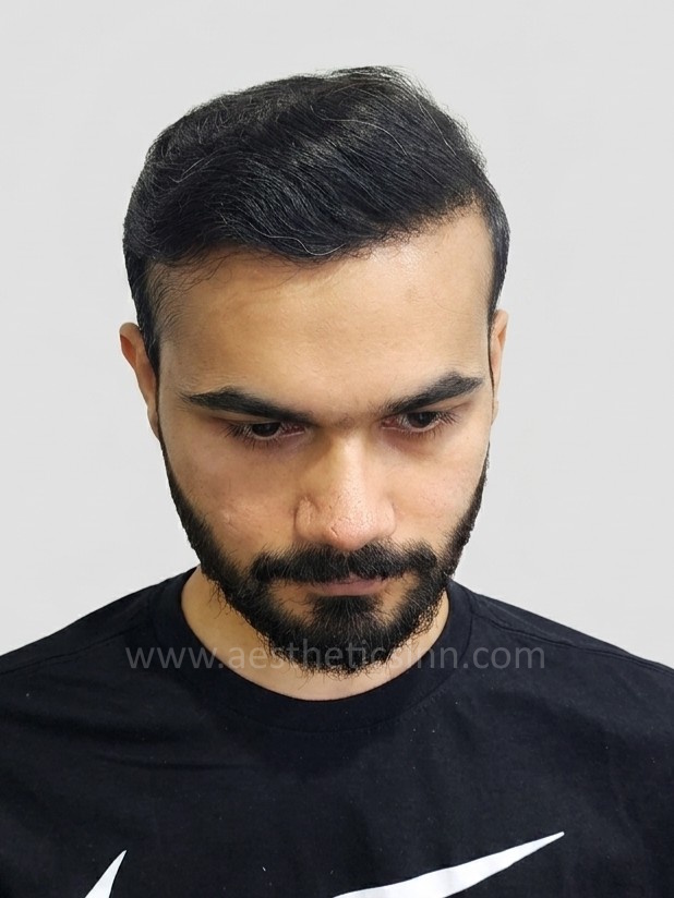 After Hair Transplant - Moiz Arshad