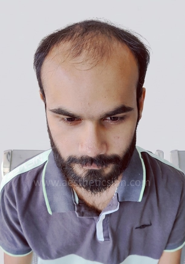 Before Hair Transplant - Moiz Arshad