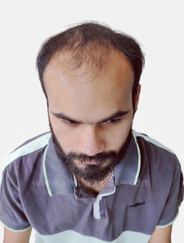 Moiz Arshad Top View Before