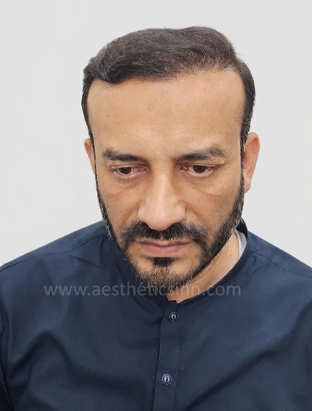After Hair Transplant - Rashid Habib