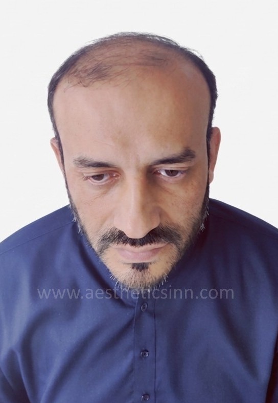 Before Hair Transplant - Rashid Habib
