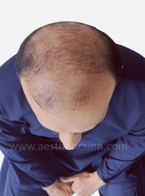 Rashid Habib Top View Before